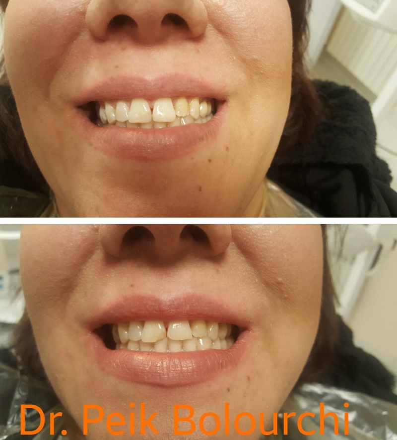 Восстановление красоты композитного зуба