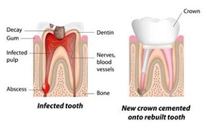 عصب کشی دندانها