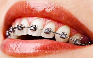 ارتودنسی دندانها